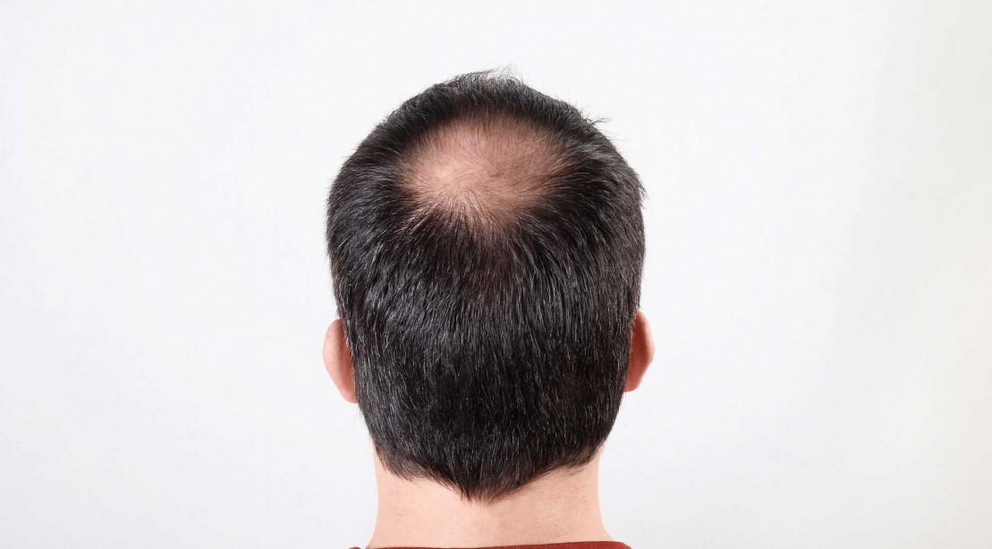 Scientists Have Found a Way to Grow New Hair Scientists Have Found a Way to Grow New Hair
